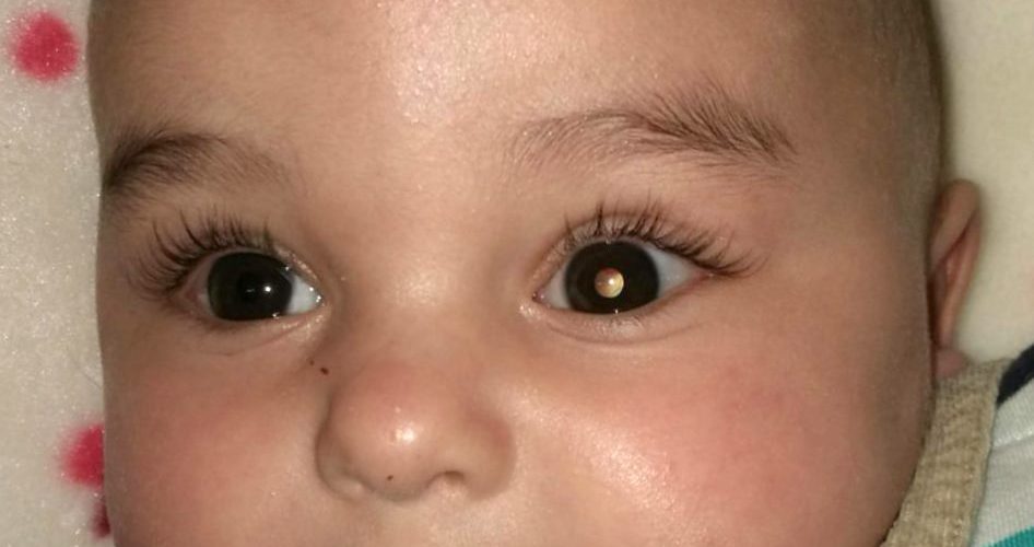 Tratan por primera vez un cáncer de retina pediátrico con un virus