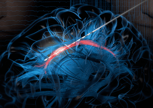 La risa puede ser la mejor medicina… ¿para la cirugía cerebral?