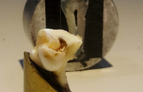 Tratamiento láser aumenta resistencia del esmalte dental