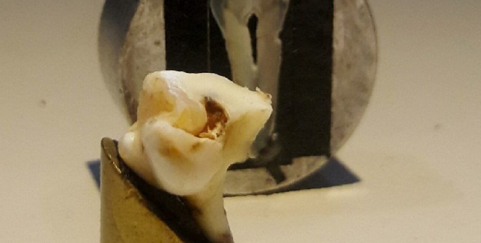 Tratamiento láser aumenta resistencia del esmalte dental
